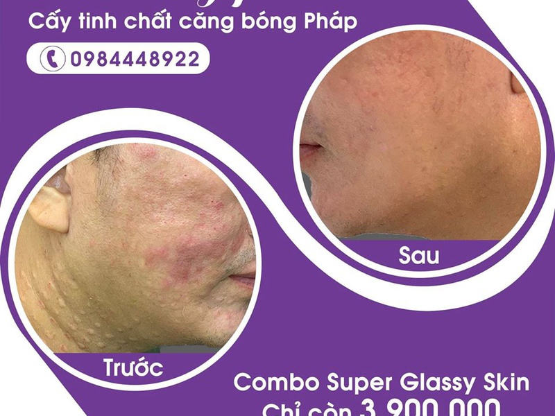 [TÂM ĐIỂM] Tiêm căng bóng da có hiệu quả không, chi phí cao không?