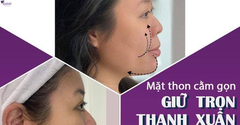 Tiêm Filler nâng cơ mặt: Mặt thon cằm gọn - Giữ trọn thanh xuân