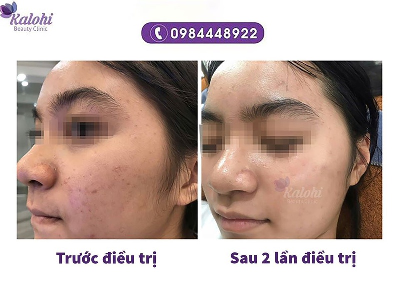 Không lo tái phát với cách trị mụn tận gốc chỉ có tại KALOHI!