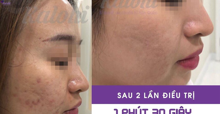 [TƯ VẤN] Cách làm mờ sẹo mụn “ngon – bổ – rẻ” tại gia