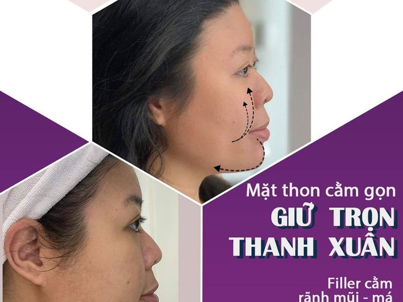 [TƯ VẤN] Tiêm Filler gọn cằm giá bao nhiêu?