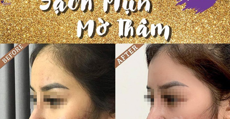 ĐÁNH TAN MỌI VẾT THÂM – TỰ TIN CHO NÀNG TỎA SÁNG