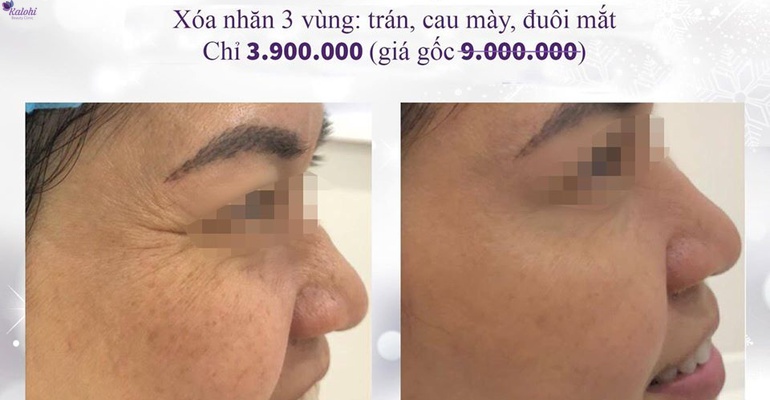 Trẻ hóa da không xâm lấn là gì?