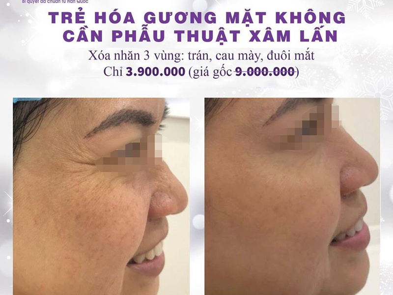 Trẻ hóa da không xâm lấn là gì?